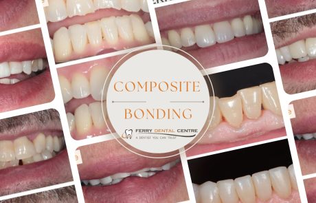 Mini-Makeovers: The Rise of Composite Bonding in Southampton