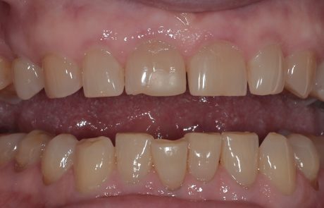 Restoring Worn Teeth and Rebalancing the Bite: An Advanced Composite Bonding Case