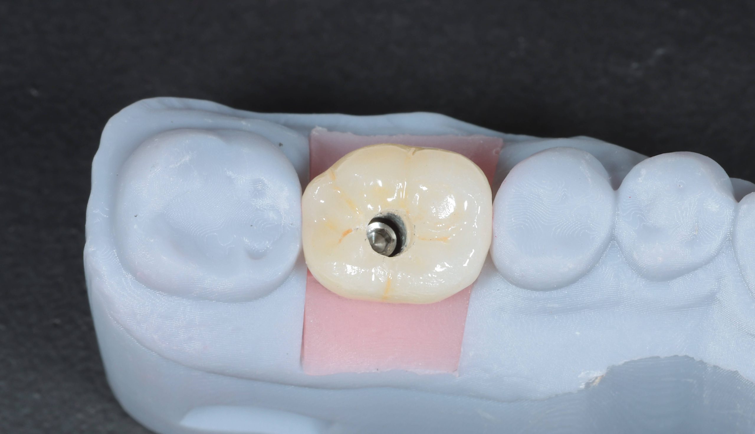 Dental implant crown on model in Southampton