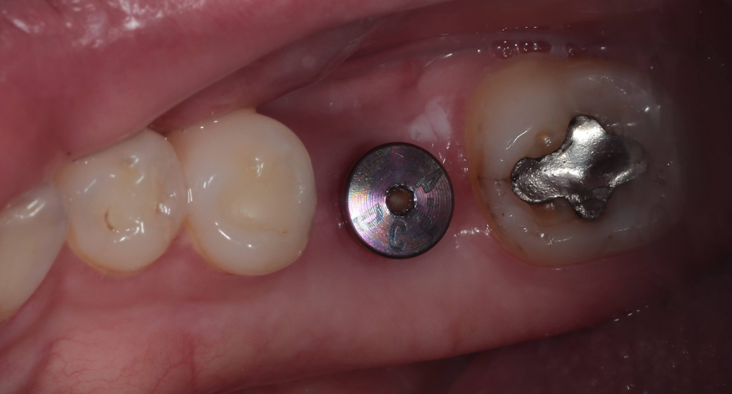 Dental implant in Southampton with healing abutment shaping the gum tissue