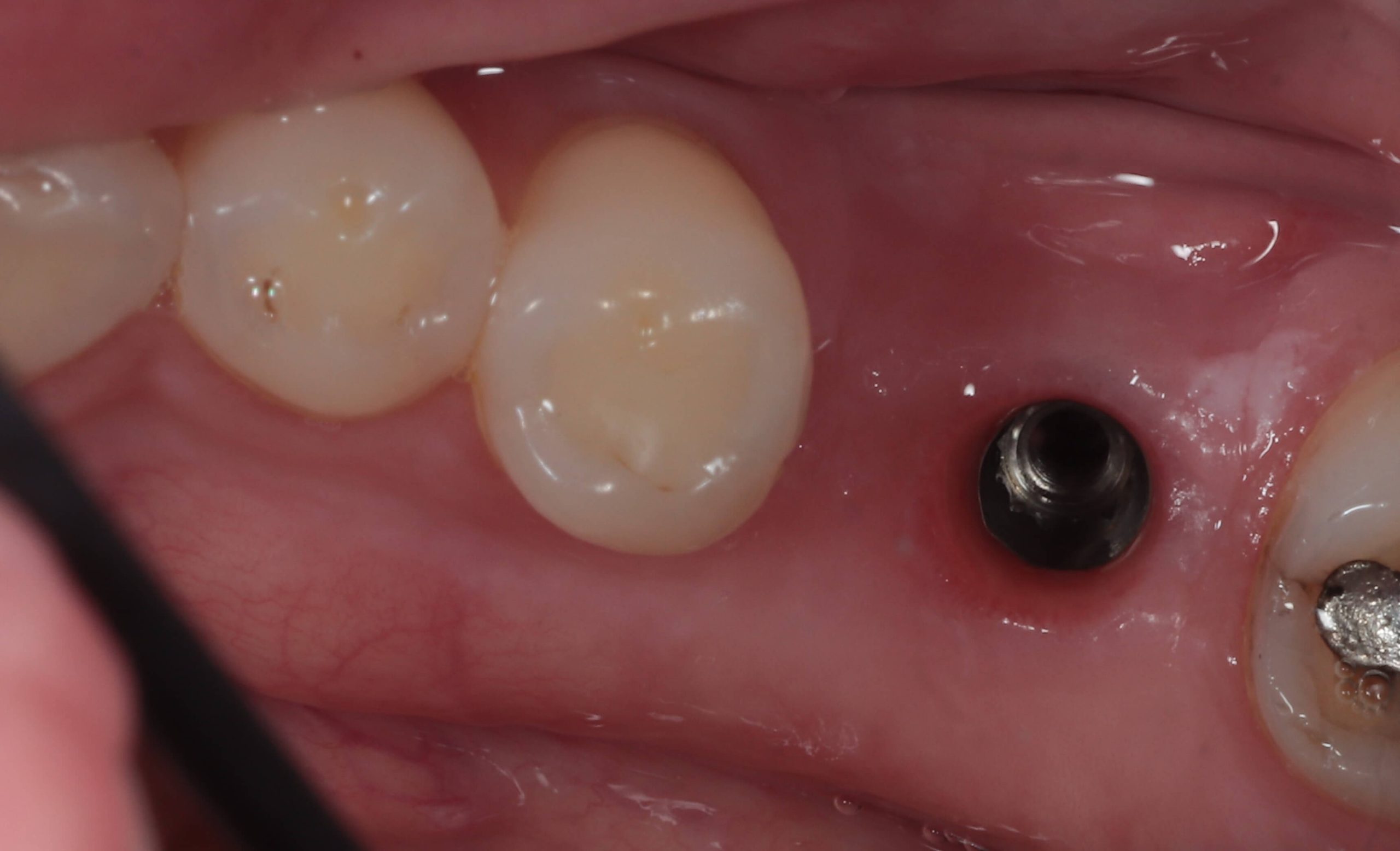 Gum tissue shaped around dental implant in Southampton after healing period
