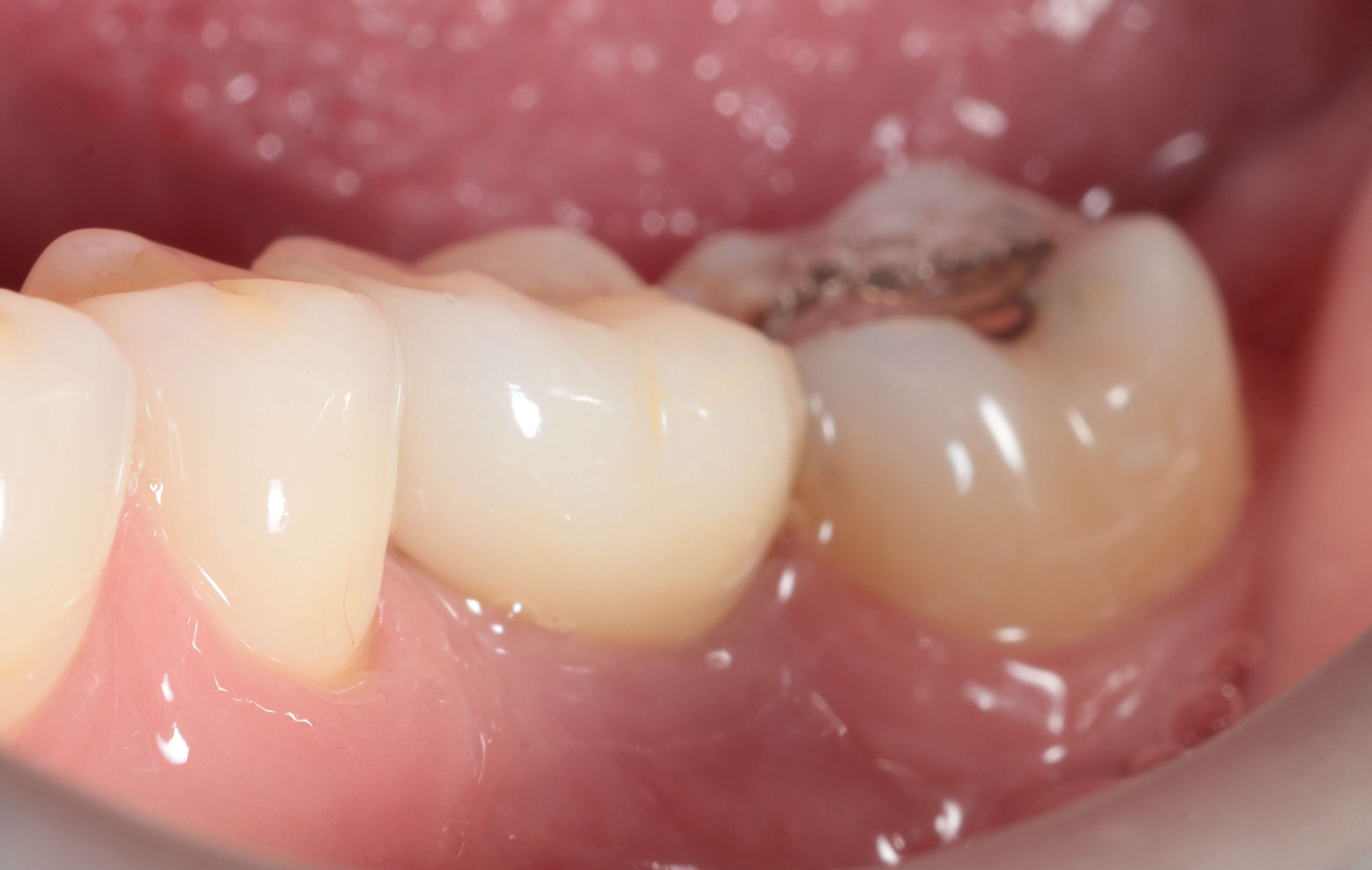 Dental implants in Southampton