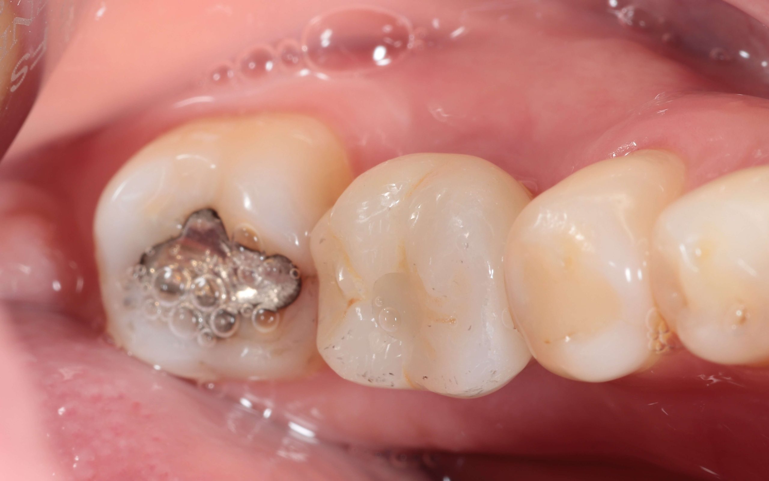 Small composite filling sealing dental implant screw in Southampton