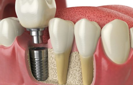 Dental Implants in Southampton: Restore Your Smile with Expert Care at Ferry Dental Centre